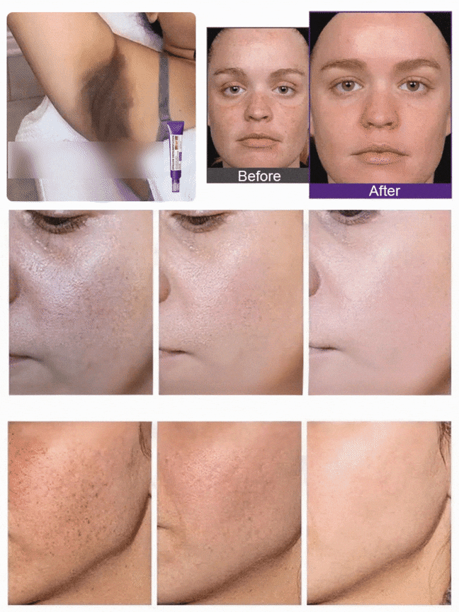 Highly effective whitening and spot-lightening cream